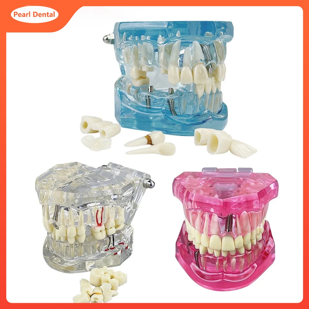 Typodont Dentaire Avec Implants Et Restaurations - Modèle De Démonstration Pour Pratique Et Formation