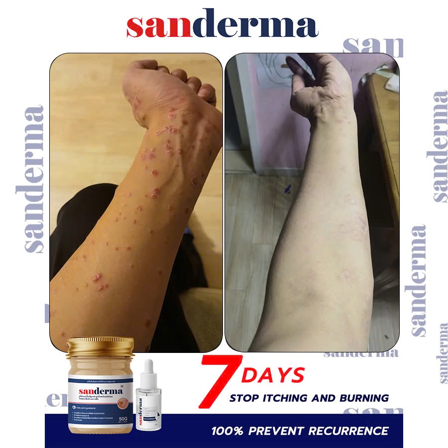 Combo SANDERMA Skin Cream 50g And Serum 30ml Helps Diaper Rash, Itching ...