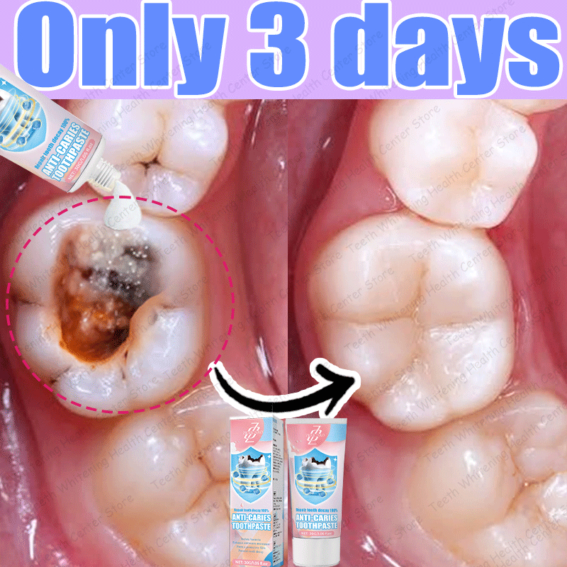 【Imported from Japan】Anti-caries toothpaste repairs cavities, removes ...