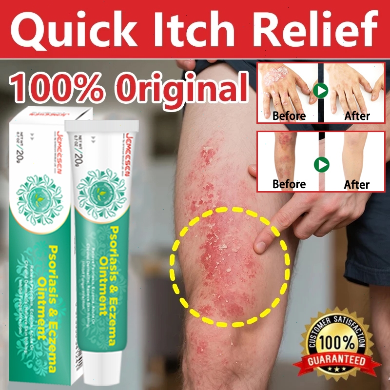 Jemeesen Eczema Cream Herbal Psoriasis Cream For Itchy Skin/Redness ...