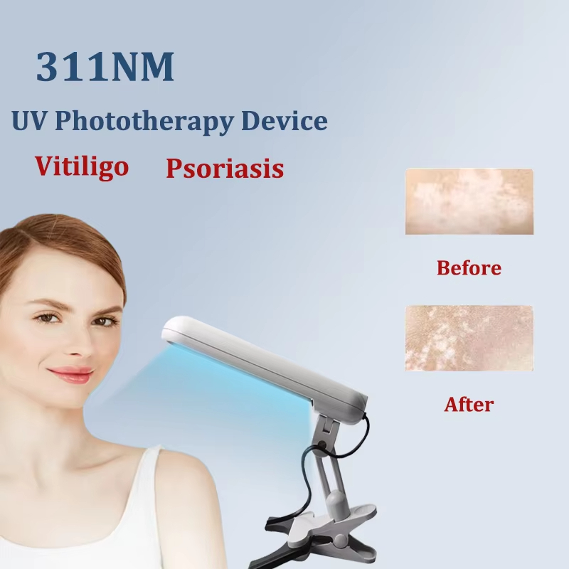 311NM UVB Phototherapy Lamp Device for Vitiligo Treatment UV NarrowBand ...