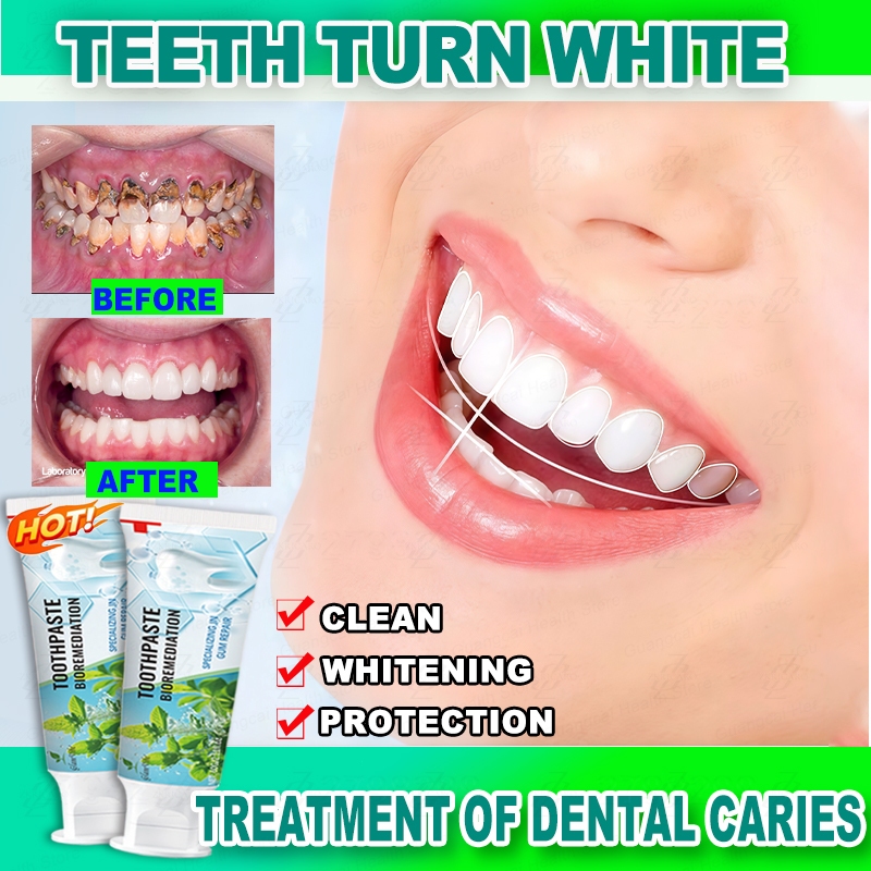 Toothpaste for tartar removal deep whitening antibacterial pampaputi ng ...