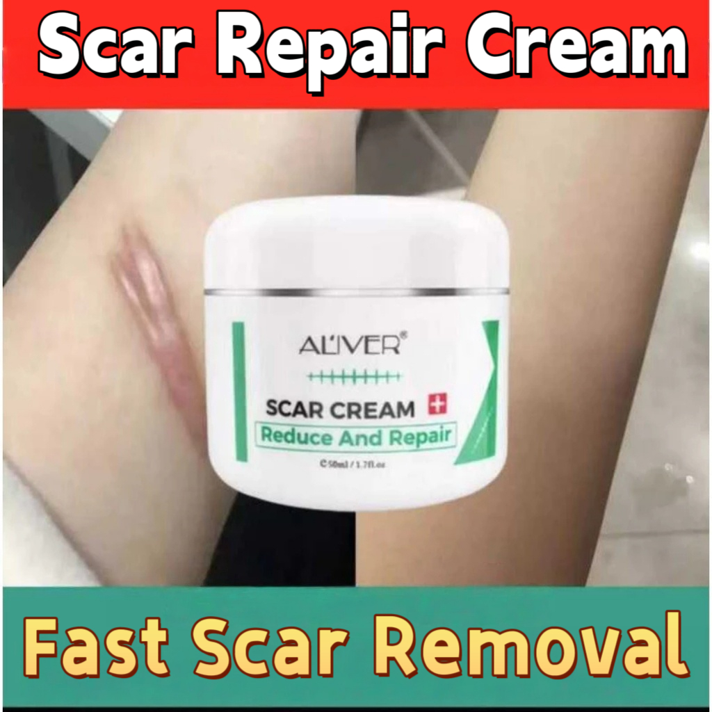 Aliver Scar Remover for Old Scar On Leg Stretch Mark Remover Scar Gel ...