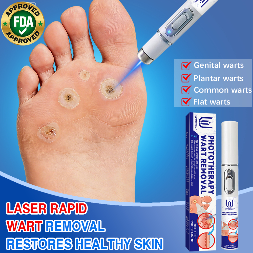 Laser wart removal: Complete removal of flat warts, filiform warts, and ...