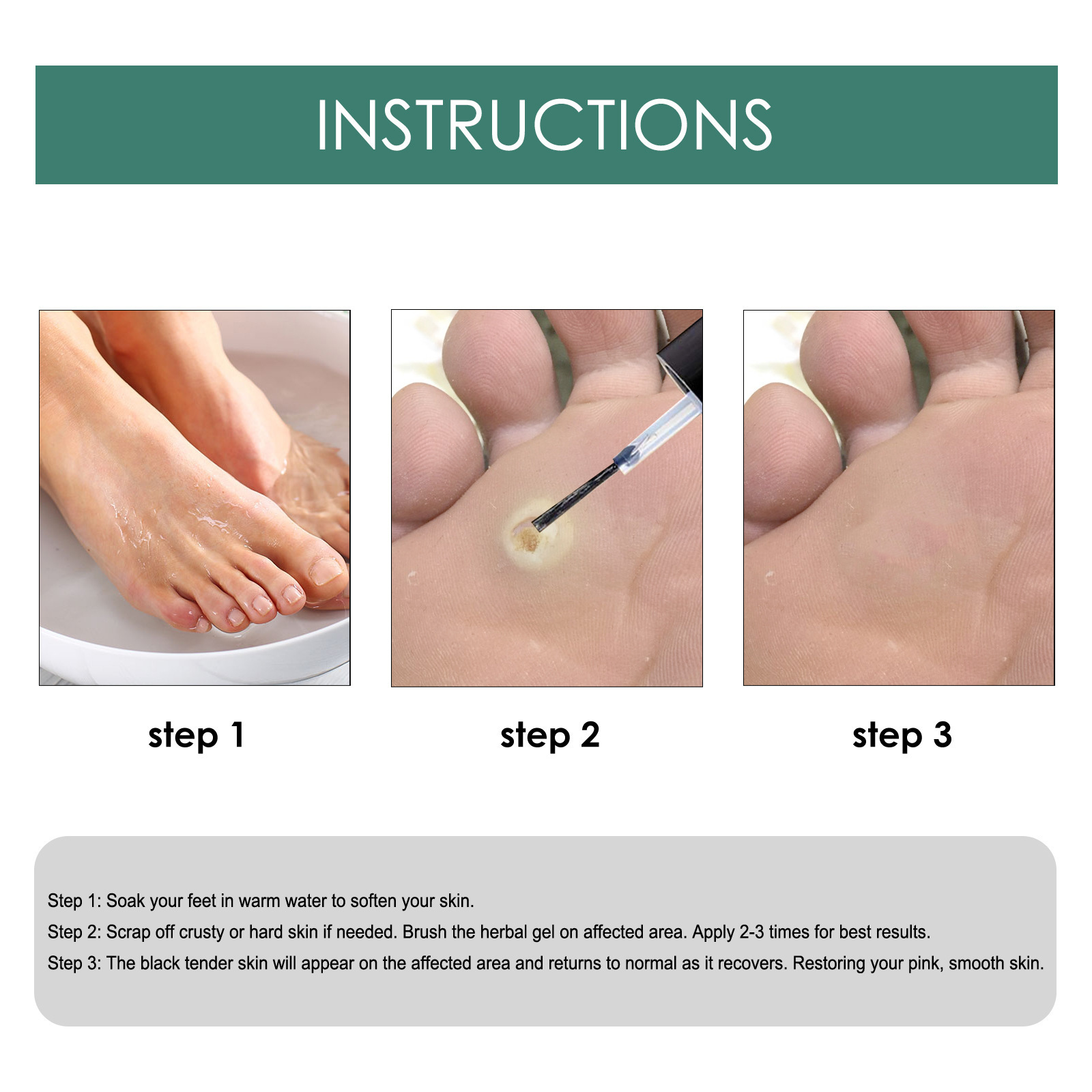 South Moon Foot Corn Removal Gel 10ml Callus Remover Liquid Extra ...