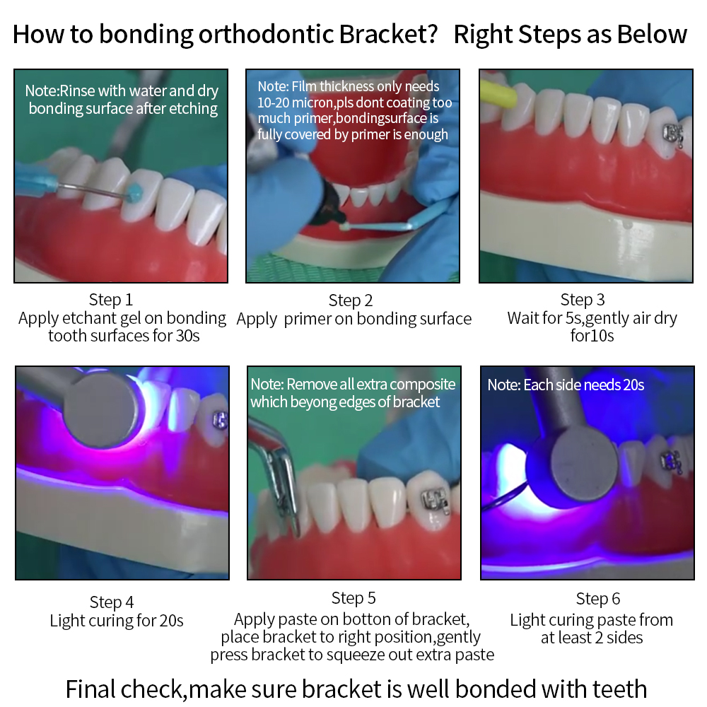 Light C//u//r//e Bonding Kit | Shopee Philippines