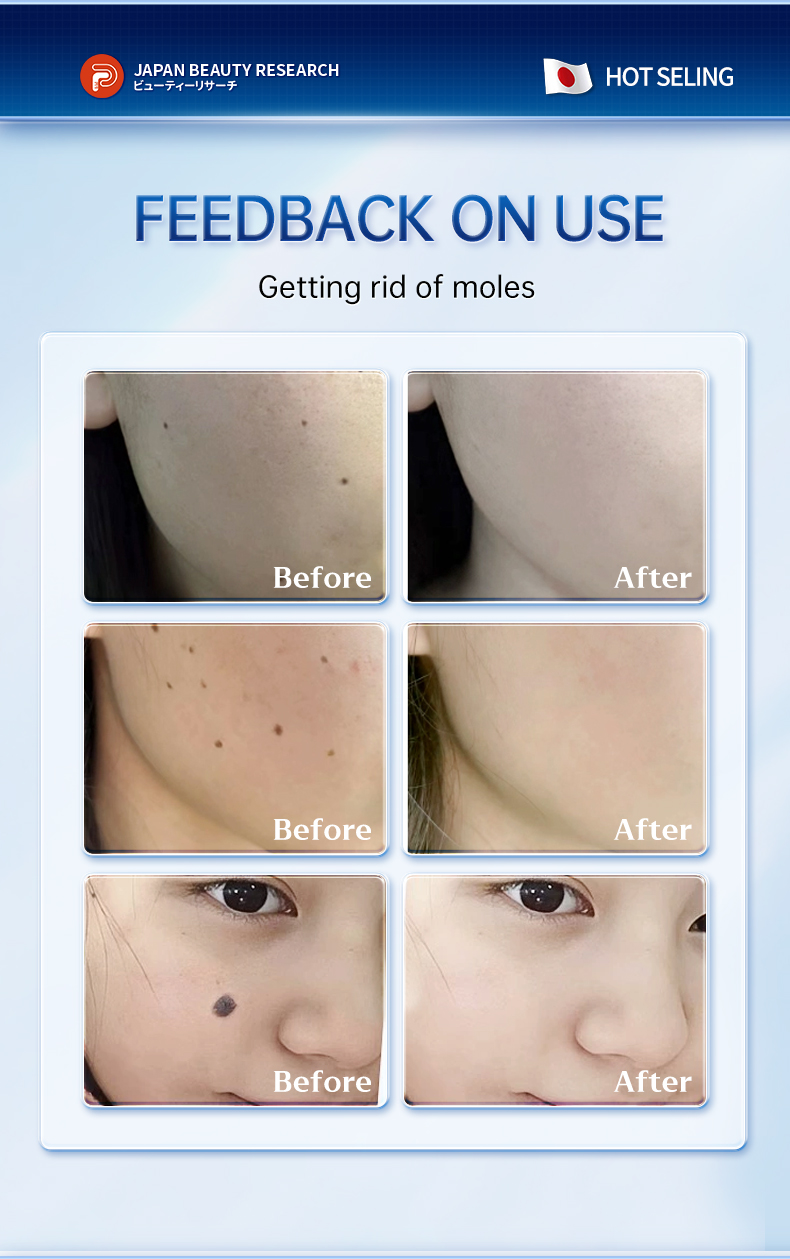 Warts Remover Original Strong Kasoy Cream Wart Removal Kulugo Skin Tags