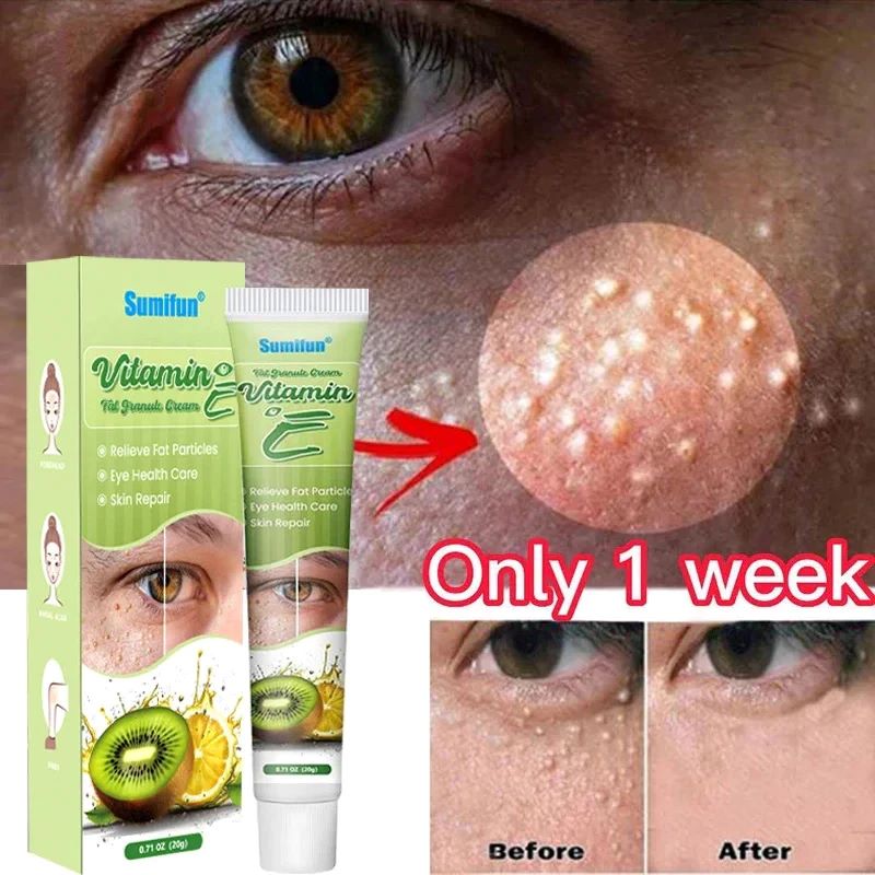 20g Vitamin E Fat Granules Remover Eyes Cream Improve Eye Bag Fade Fine