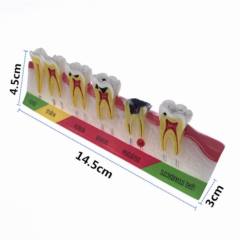 Teeth Periodontal Disease Model Dental Caries Breakdown Display Periodontitis Show Teaching Tooth Model Dentist Communication - View #10