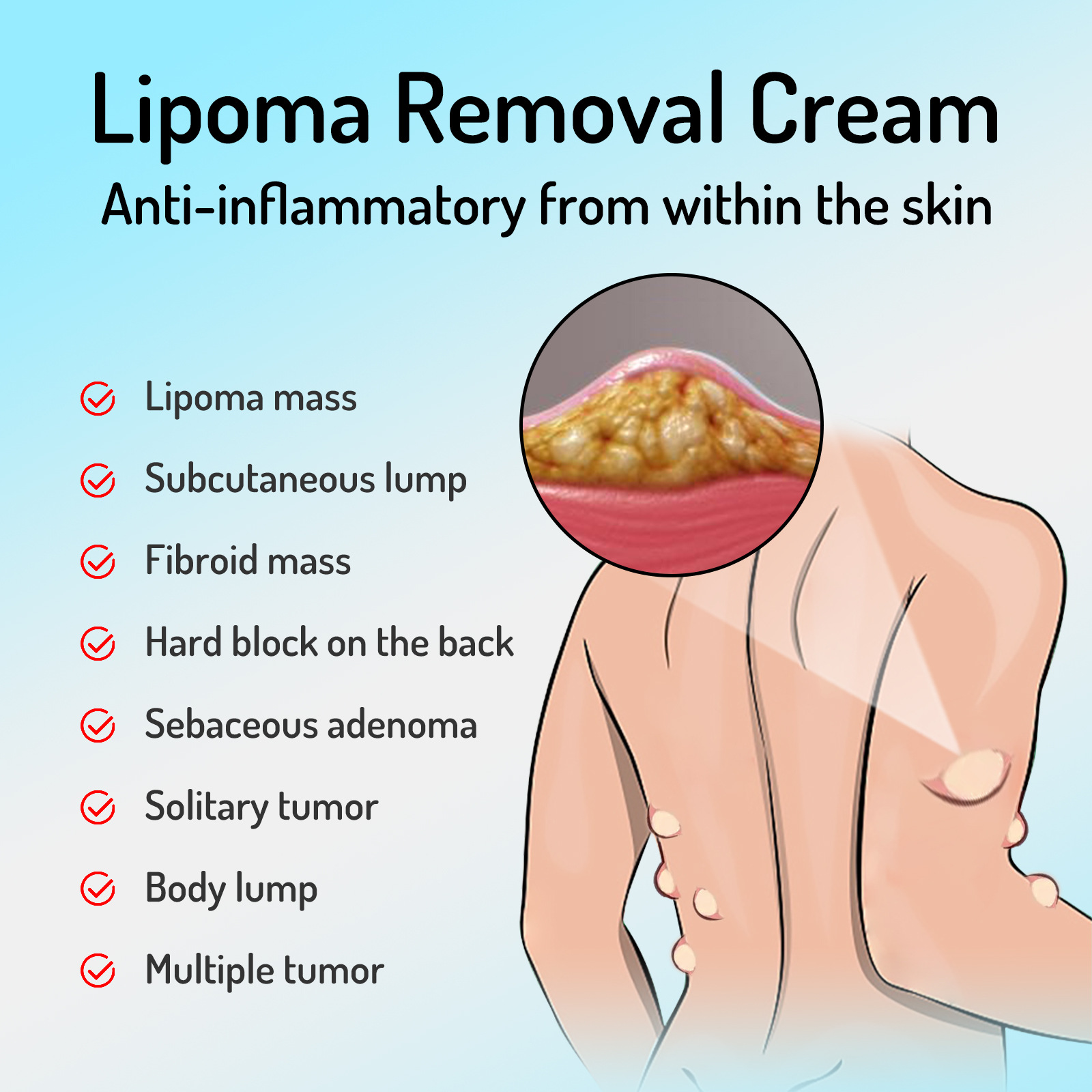 New Lipoma Removal Cream, Relieve Cream for Inflammation, Fibroids ...