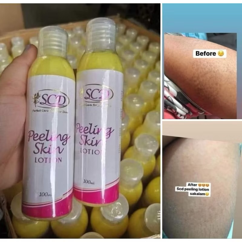 SCD 100ml Peeling Skin Lotion BOGO - Whitening, Scar Spot Removal, Skin ...