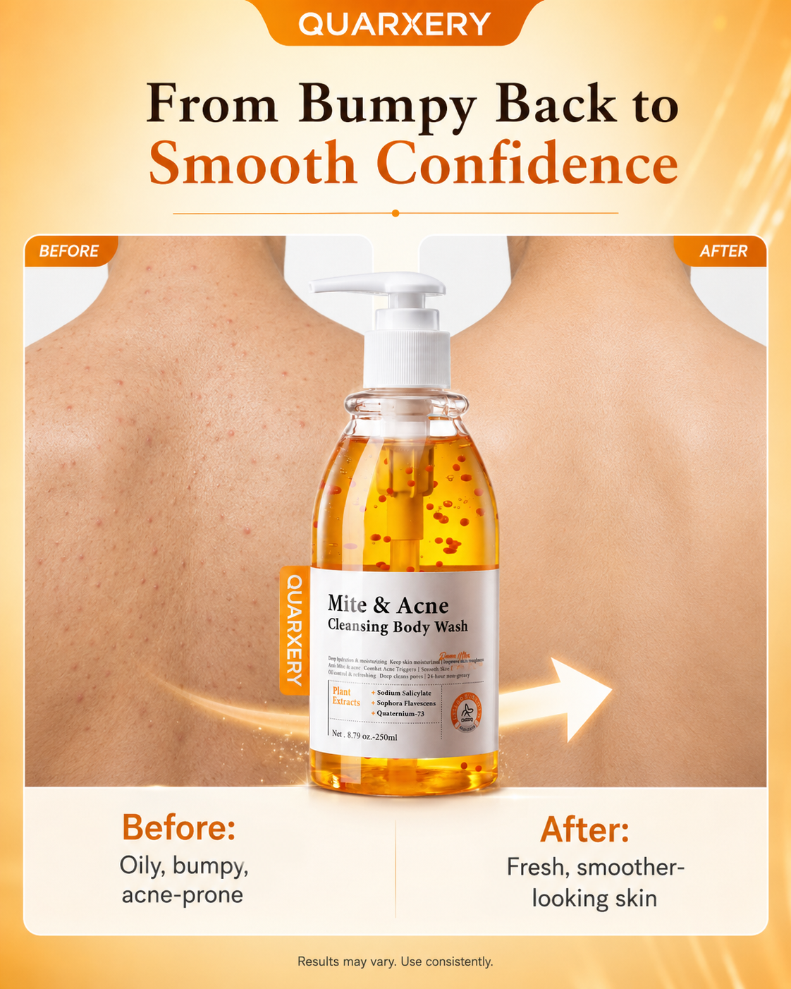 【Original】QUARXERY Anti-Mite & Body Acne Wash 250ml | Salicylic Acid ...