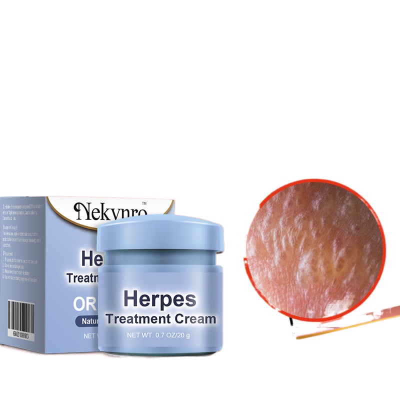 Shingles Cream 20g Treatment Genital Herpes Natural Formula Herpes Medicine gamot sa buni for
