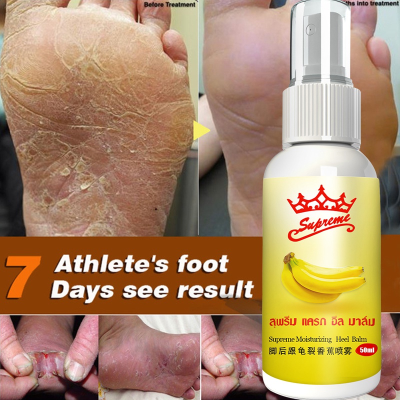 Anti Fungal Infections Foot Spray for Athlete's Foot Treating Beriberi