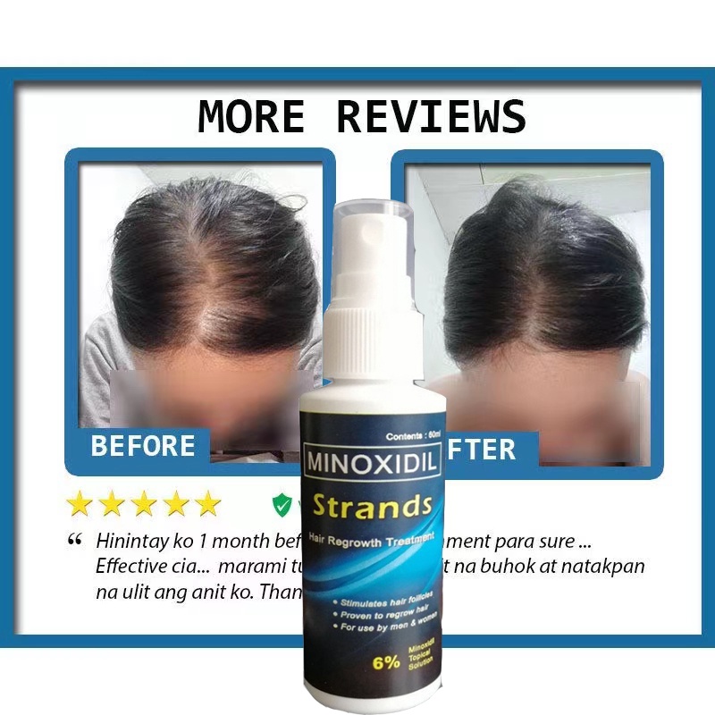 30ml Minoxidil Strands 6% Minoxidil Topical Solution (60ml per bottle) Hair  Grower beard Grower | Shopee Philippines