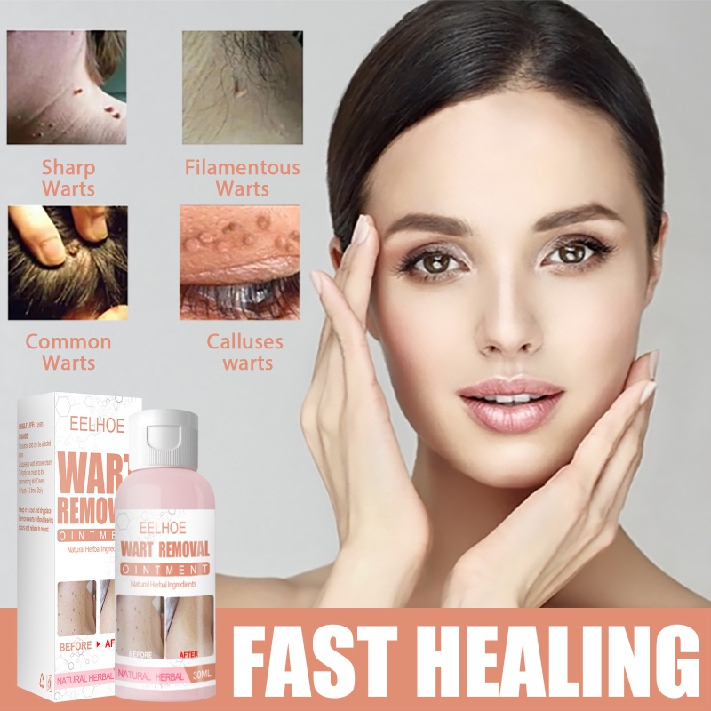 ☒EELHOE 30g Skin Tags Warts Remover Cream Face Body Tag Remover Foot