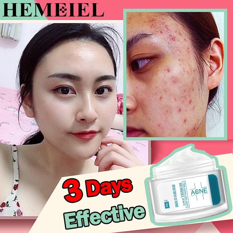 Hemeiel Acne Scar Remover Cream/Pimple Removal Cream/Skin Care Products ...