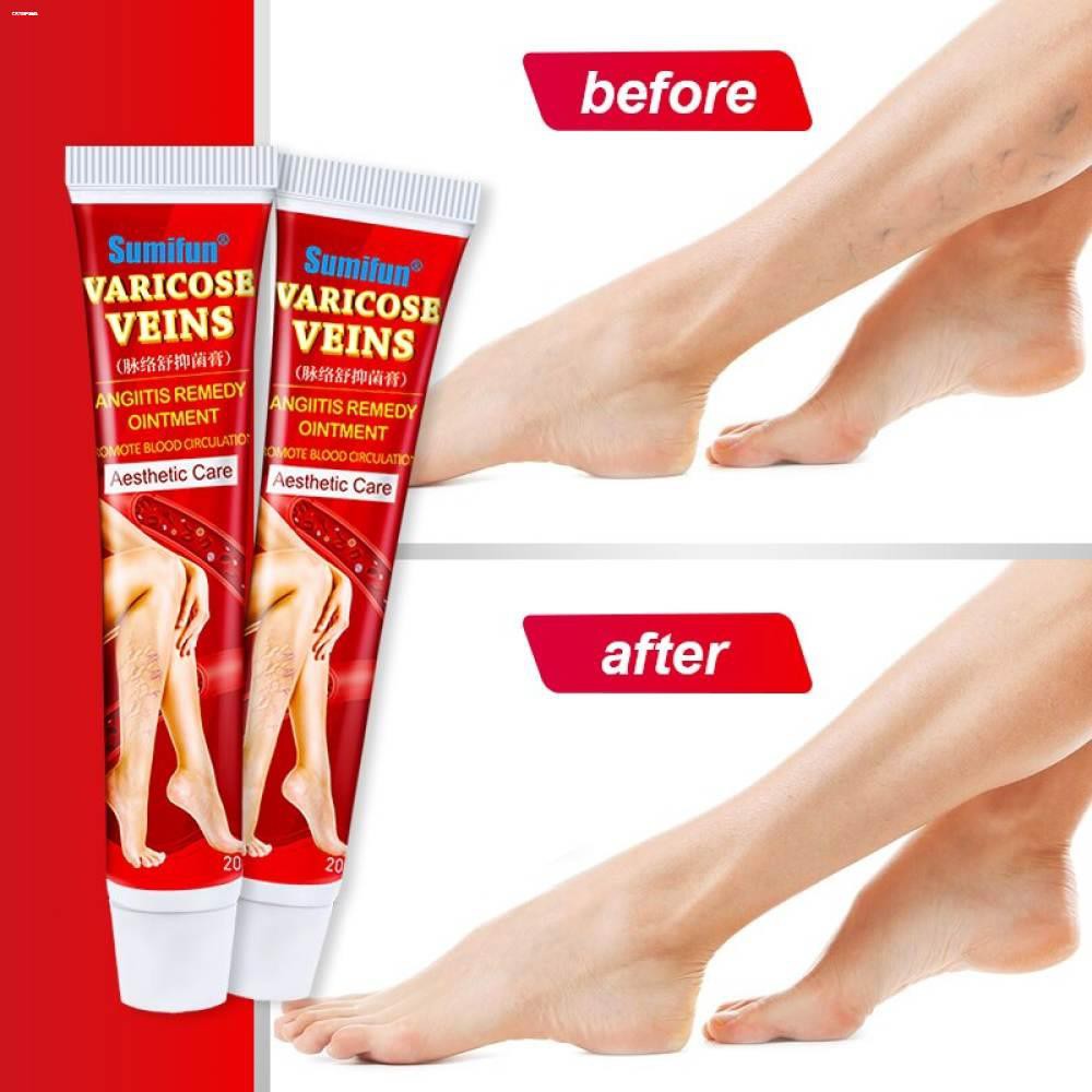 WHITENING CREAMALOEVERA GEL♚☬Varicose Veins Remover Varicose Vein Treatment Cream Vasculitis
