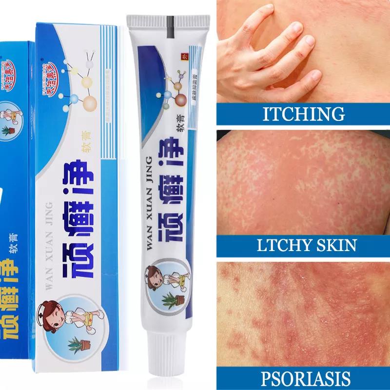 Antibacterial Psoriasis Cream Effective Anti-itch Relief Dermatitis ...