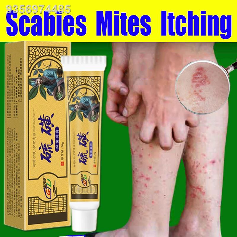 Scabies Treatment For Human 20g Scabies Ointment Sweep Away Mites