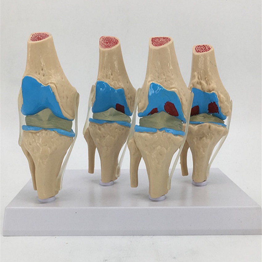 1pcs Anatomical Human Knee Joint Model Human Stage 4 Knee Joint Model ...