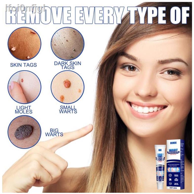 ♨Body Warts Remover Cream Corn Skin Tag Ointment Plaster Genital Wart