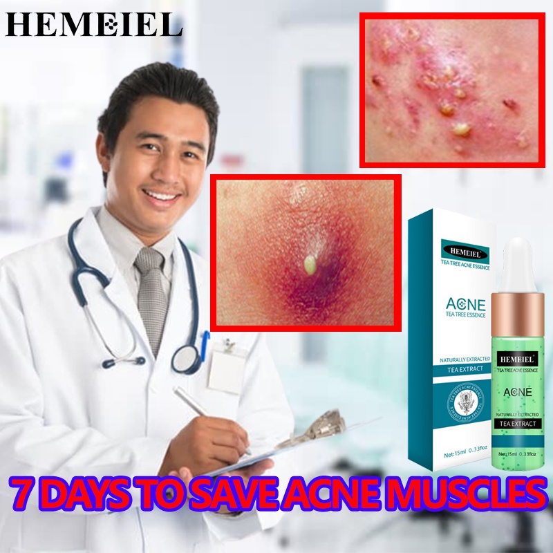 HEMEIEL Acne Remover/Benzac Benzoyl Peroxide/Fade Back Acne Marks