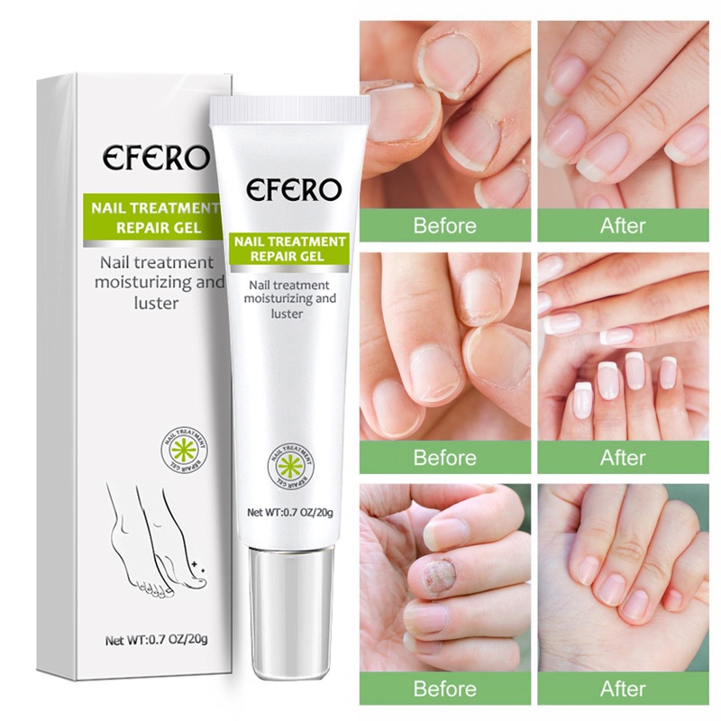 Efero Nail Fungus Treatment Gel Antiinfective Removal Paronychia