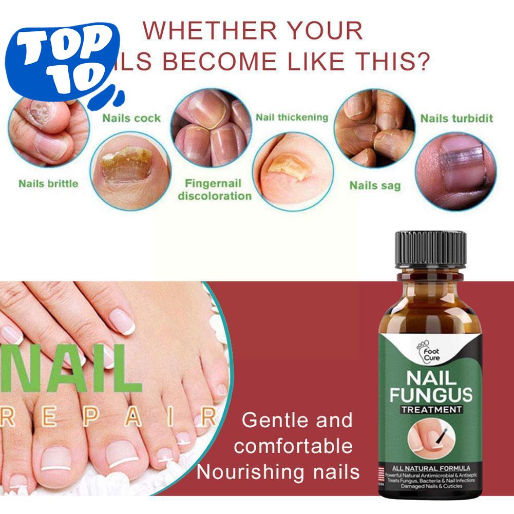 NEW☏Fungal Nail Repair Essence Serum Care Treatment Whitening Toenail