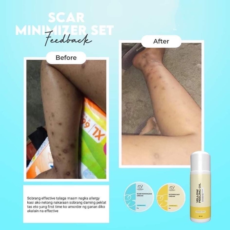 PEKLAT Treatment Cream/Lightening Scar/Scar Minimizer set Shopee
