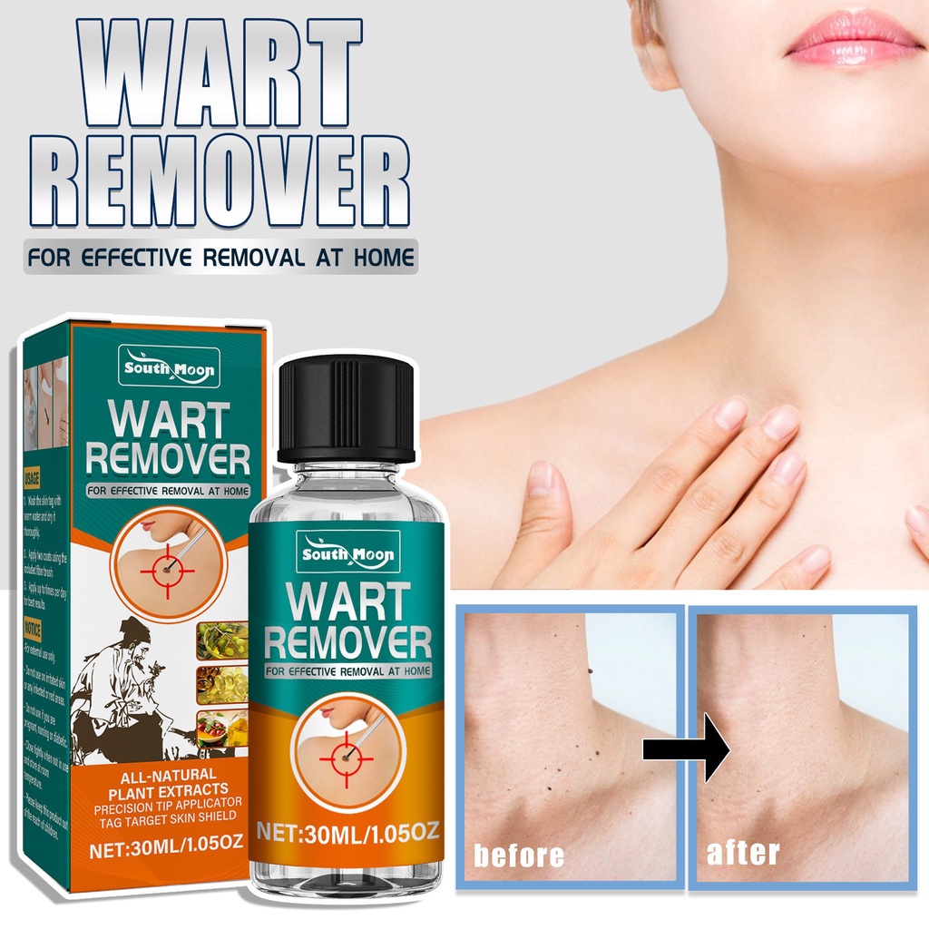 South Moon Wart Removing Liquid Wart Removing Liquid Derusting Removing ...