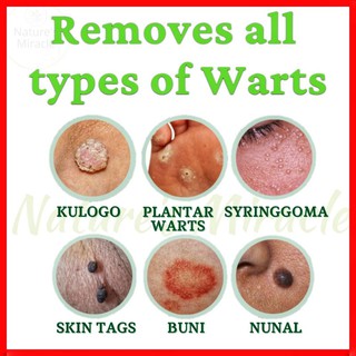 Natures Miracle Kasoy Oil Organic & Effective Wart Remover Kulugo Mole ...