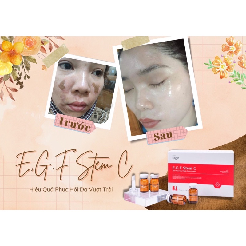 Egf Stem Cells Restore Damaged Skin, Pitting Scars, Heal Wounds