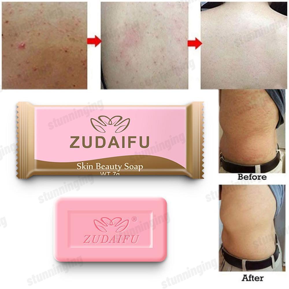 Sulfur Soap Skin Cleansing Acne Sebum Antifungal Bath Soap Anti Mite