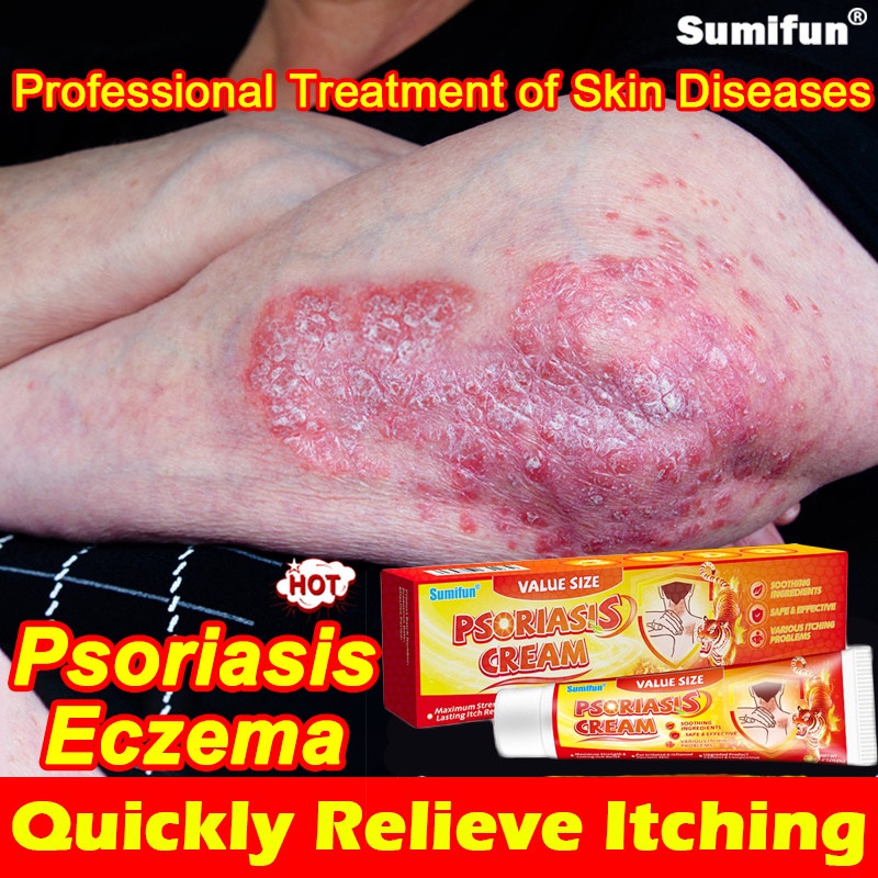 ﹊Sumifun Eczema Cream 60G Psoriasis Treatment Itchy Skin Ointment ...