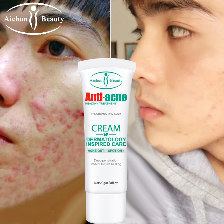Acne Pimple marks remover cream Anti dark spots Treatment whitening