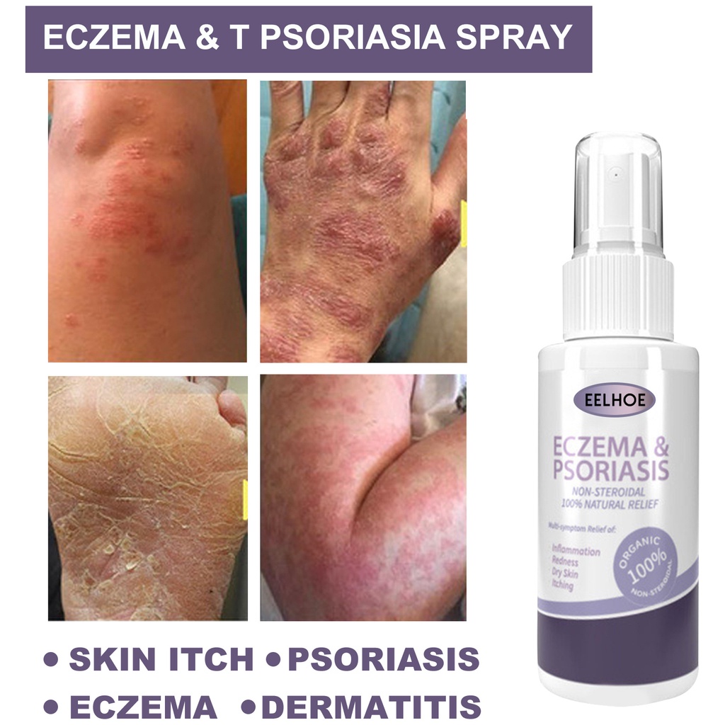 50ML Skin Psoriasis Spray Dermatitis Eczematoid Antibacterial Dressing ...