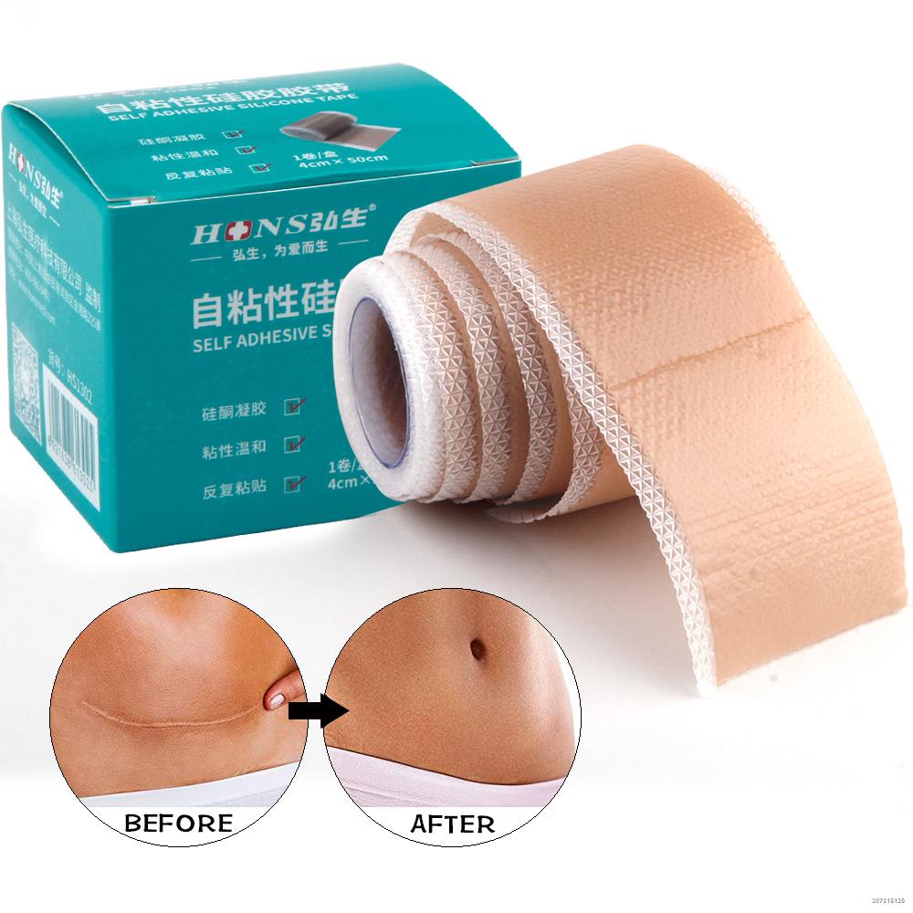 pananggal-ng-peklat-silicone-gel-scars-sheet-patch-treatment-removal