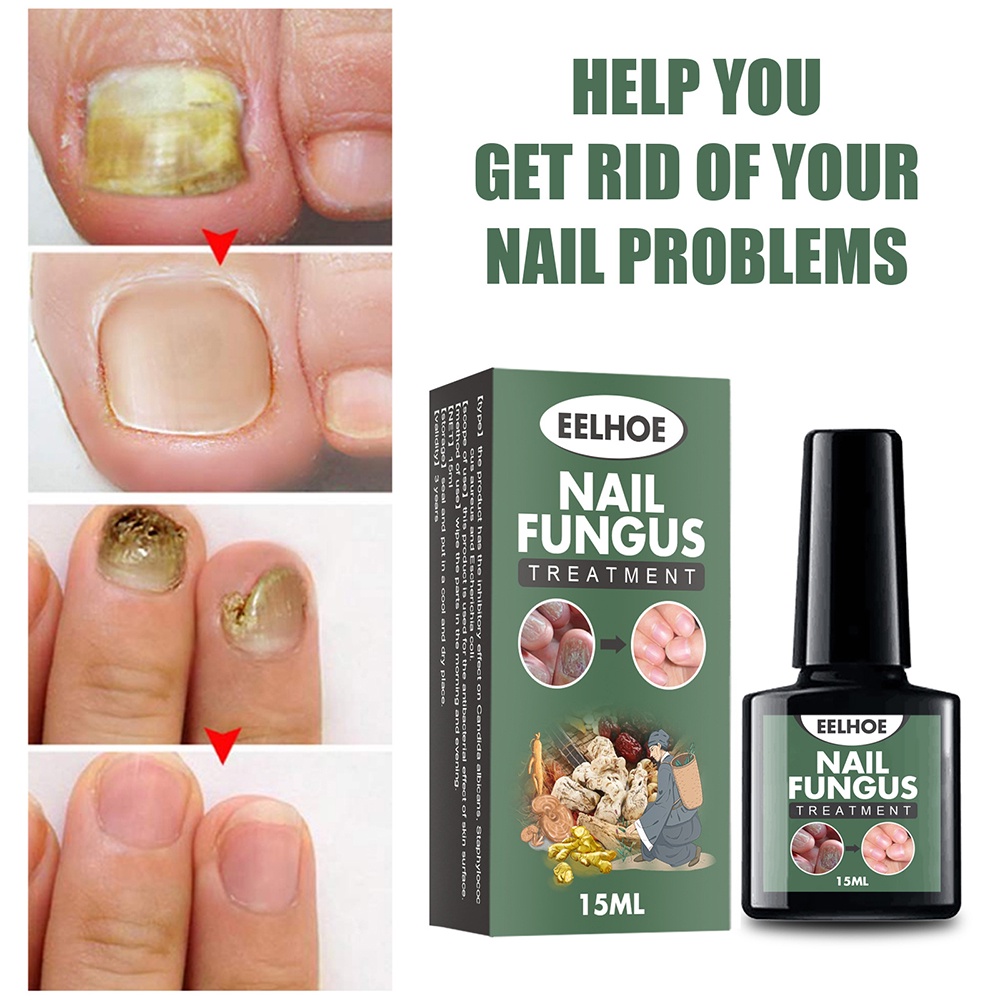 Nail fungus repair treatment Care Cream Essence Anti Fungal nail