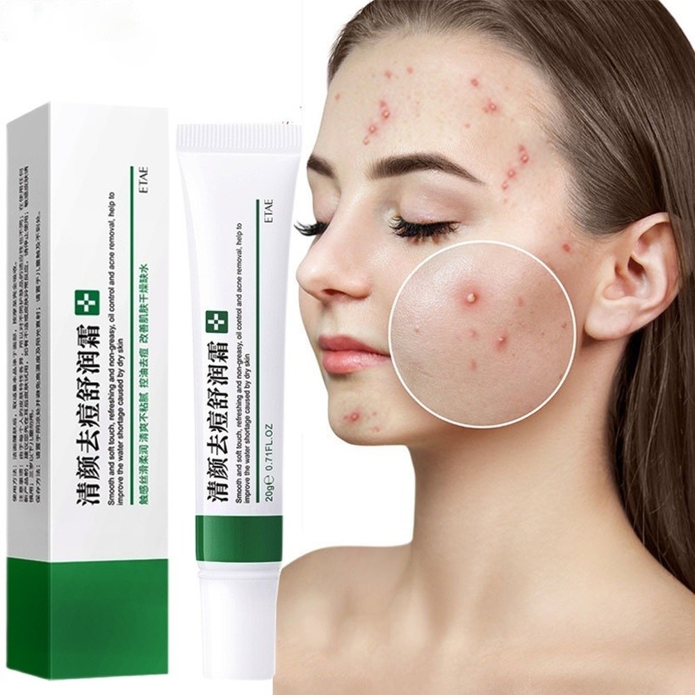 Acne cream acne treatment fade acne spots oil control shrink pores