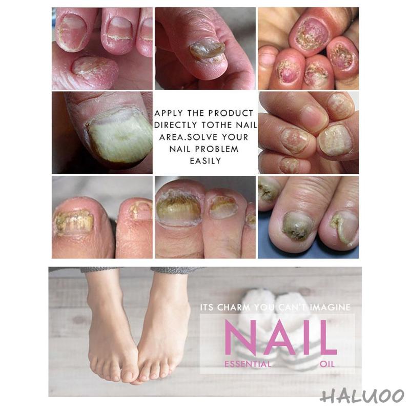 10ml Fungal Nail Toenail Treatment Essence, Maximum Strength Repair