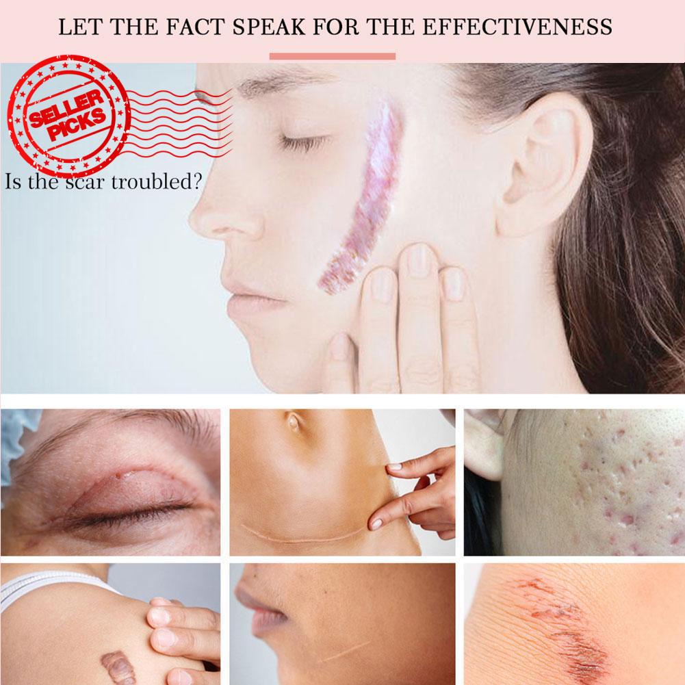 Yoxier Lavender Scar Repair Cream Pigmentation Corrector Calm Stretch