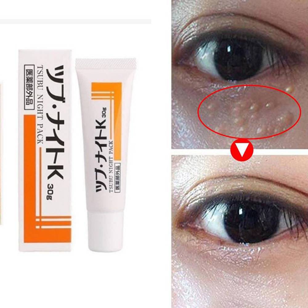 Tsubu Night Milia Pack (Oil Bumps) / Wart Remover Cream 30g Eye Cream