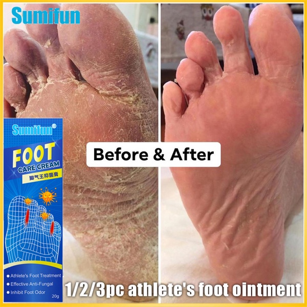 SUMIFUN Anti-fungal treatment cream,Beriberi cream,Foot Ringworm cream ...