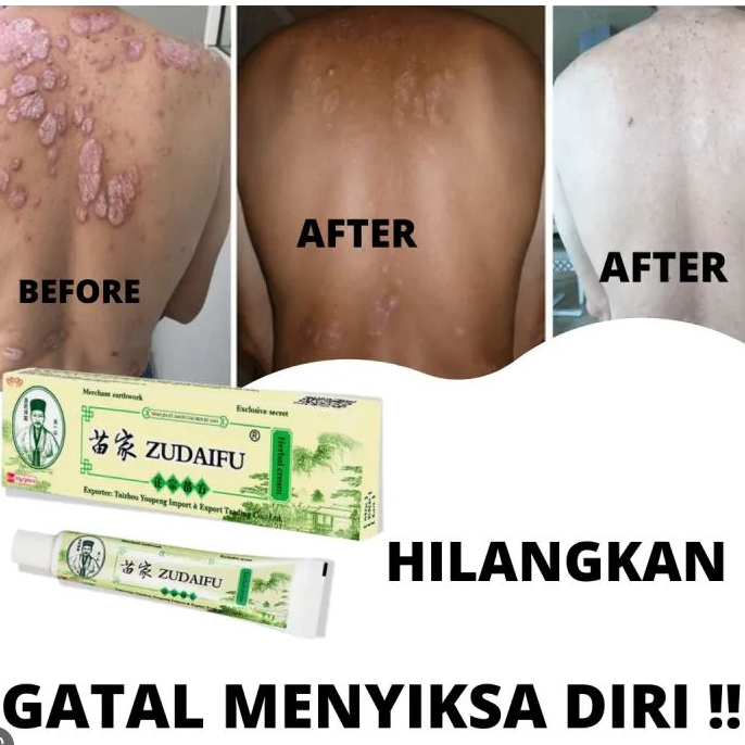 Itching Medicine For Scabies Ringworm Acne Back Eczema Skin Fungus