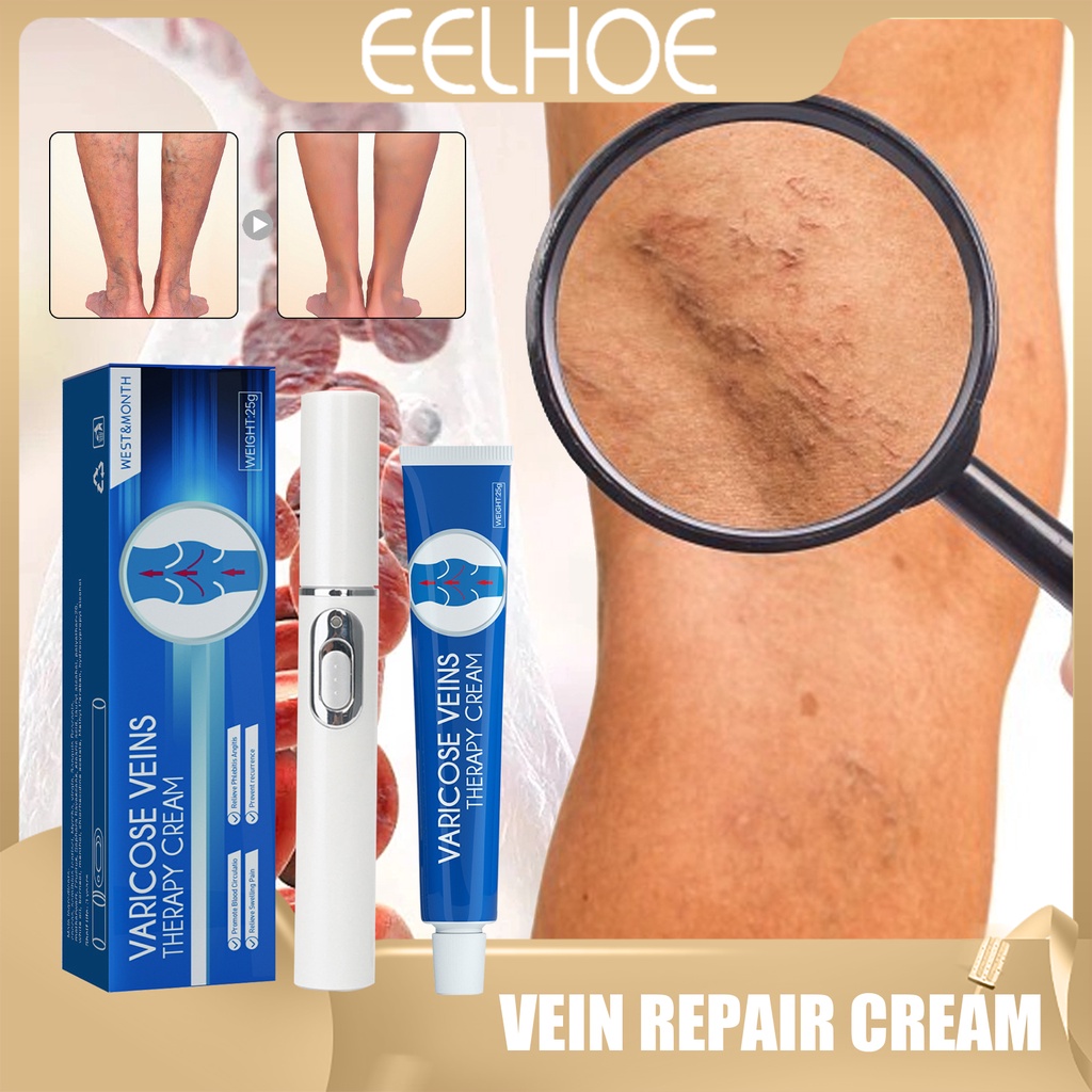 EELHOE Varicose Remover Cream Veins Treatment Vein Repair Relieves ...