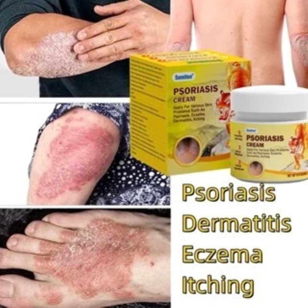 Sumifun psoriasis cream dermatitis Sensitive skin Tunea Pedis Ubat ...