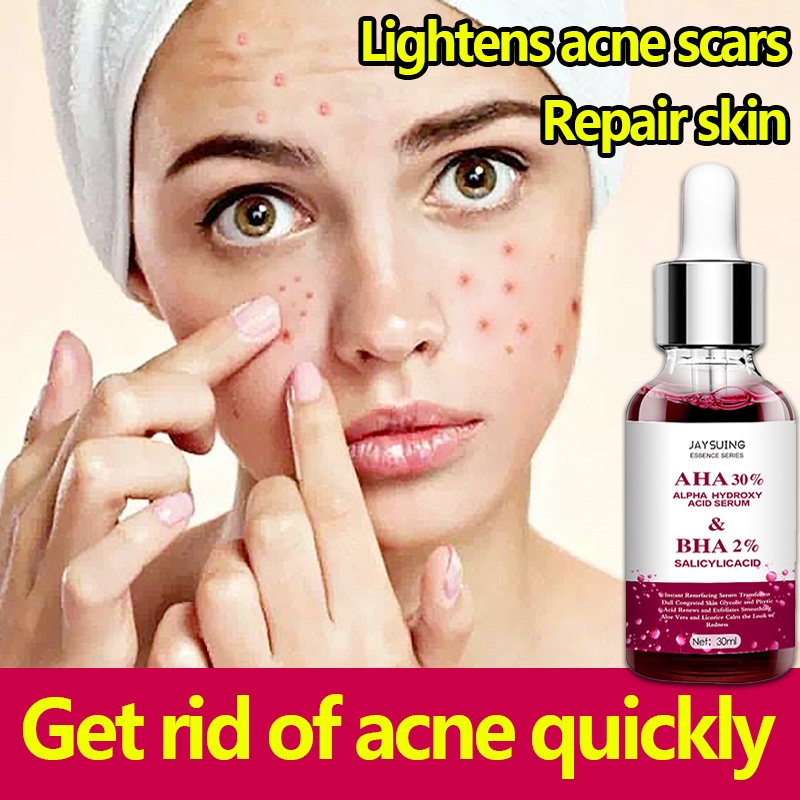 Acne Treatment Serum Face Acne Pimple Treatment acne scars remover for