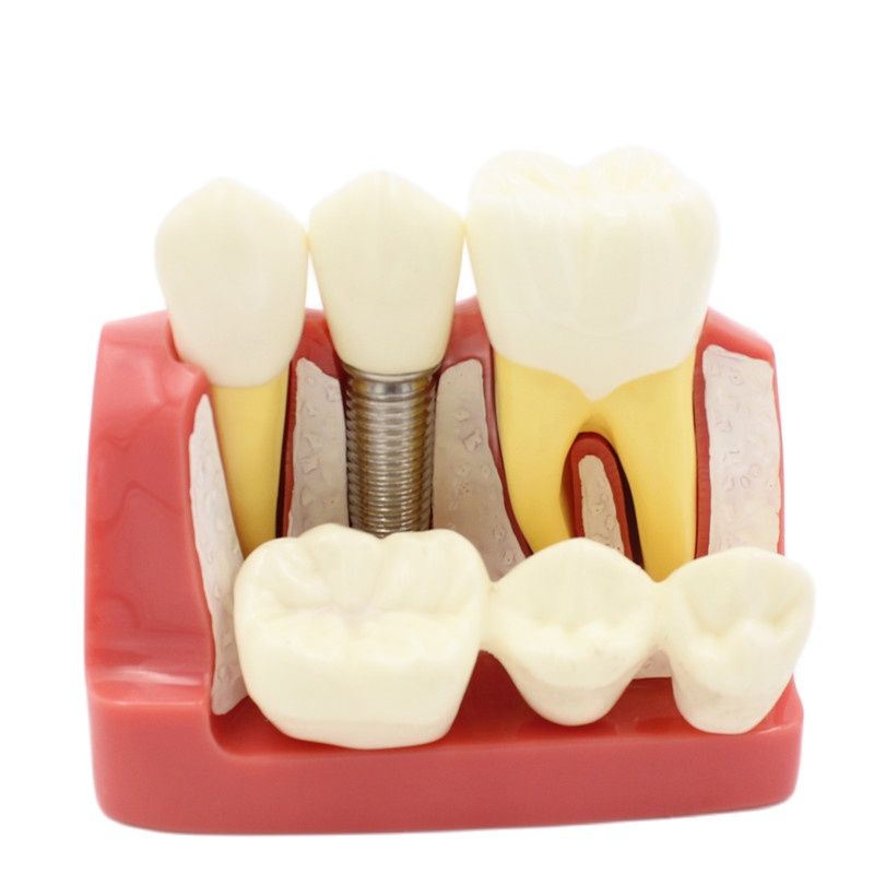 Dental Demonstration Teeth Model For Orthodontic Practice - Implant, Crown & Bridge Analysis (1 Piece)