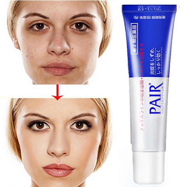 Japan Pair Anti Acne Cream 24g Pimple Marks Remover Face Acne Pimple
